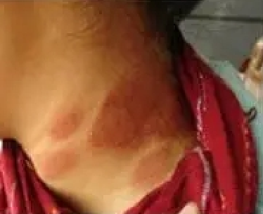 兰州华医皮肤病研究院 为什么再发性皮炎不能吃辣